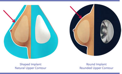 Can You Tell Round from Shaped Breast Implants? - Northwest Center